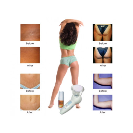 AS23 CELLULESS MASSAGER 
